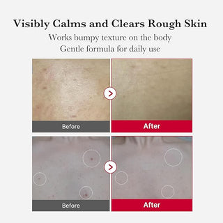 [Medicube] Red Acne Body Peeling Shot 2.0 110g, AHA + BHA Exfoliating Body Spray